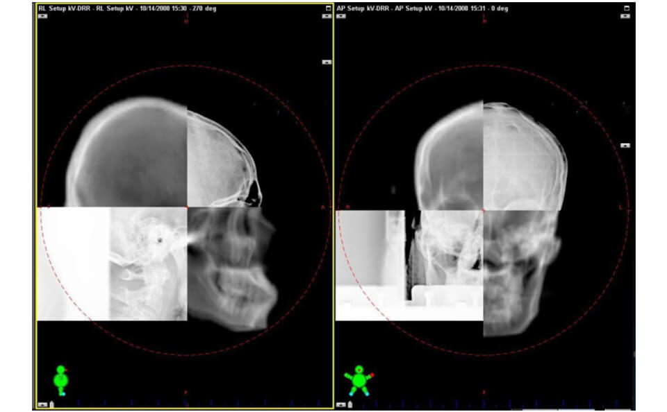 ｋV-X線画像と計画CT再構成画像との位置合わせCBCT