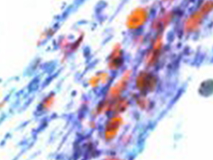 喀痰中の癌細胞(パパニコロウ染色)